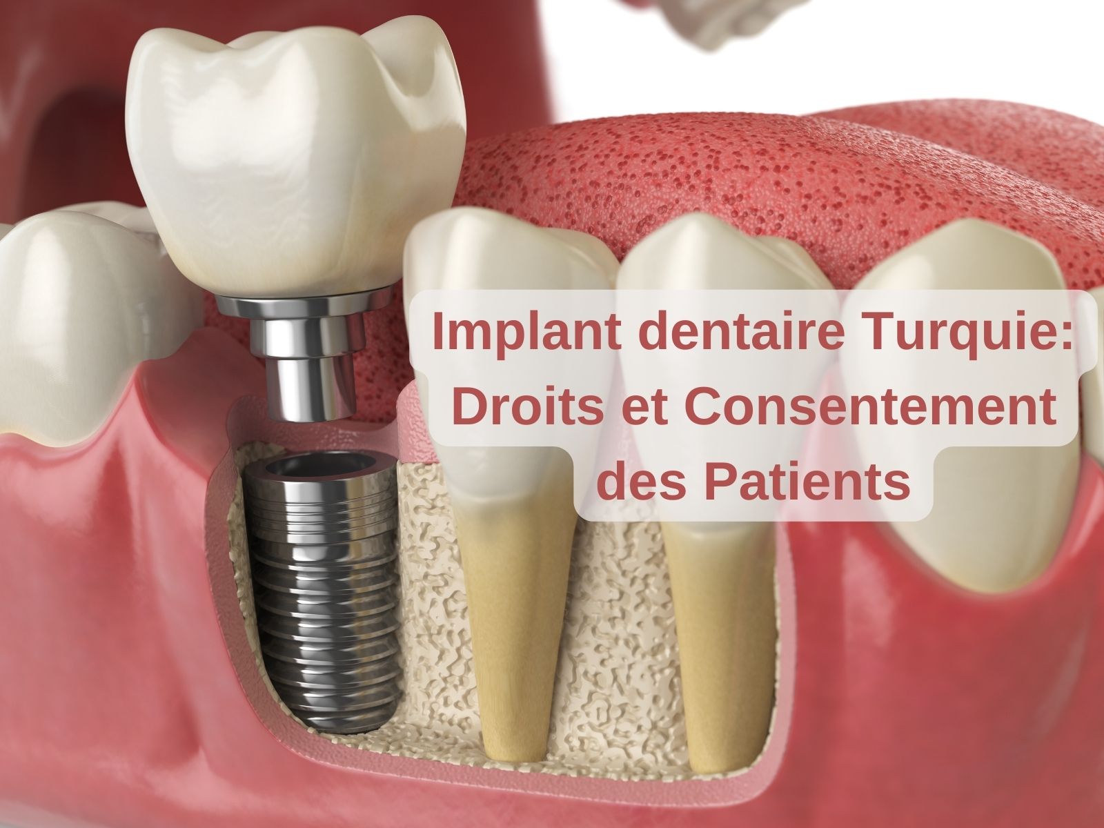 Implant dentaire Turquie : Droits et Consentement des Patients